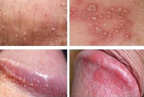 Hình ảnh nổi mụn ở vùng kín nam